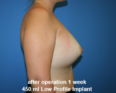 plastic-surgery-breast-augmentation